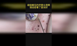 挤黑头视频,专业技巧与注意事项